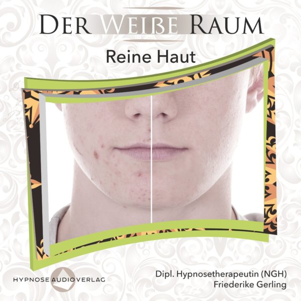 Der Weiße Raum: Hypnose bei Akne